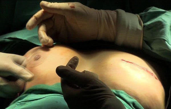Reconstrucción de mama: nueva técnica permite recuperar la sensibilidad