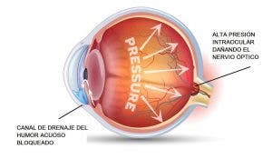 Infografía del glaucoma.