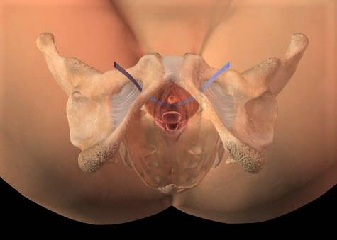 Recreación que muestra la malla que se coloca bajo la uretra y se pasa por los agujeros obturadores en la zona pélvica.