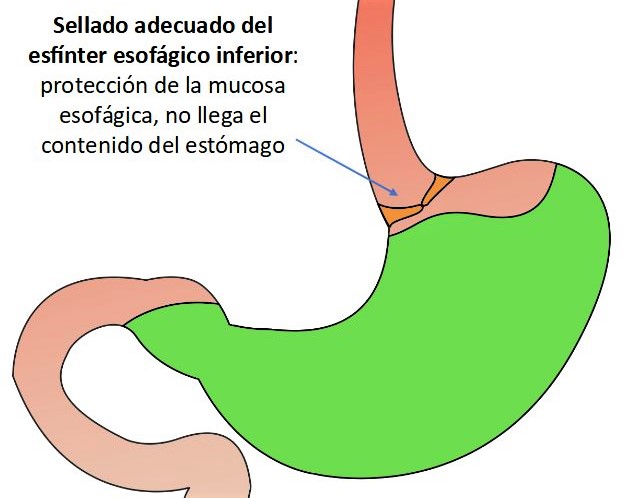 El esfínter esofágico inferior abre o cierra la posibilidad de sufrir reflujo gastroesofágico