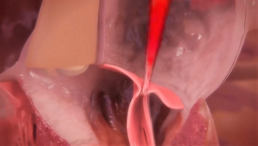 Simulación de una válvula mitral dañada: se escapa sangre por la insuficiencia de sus velos