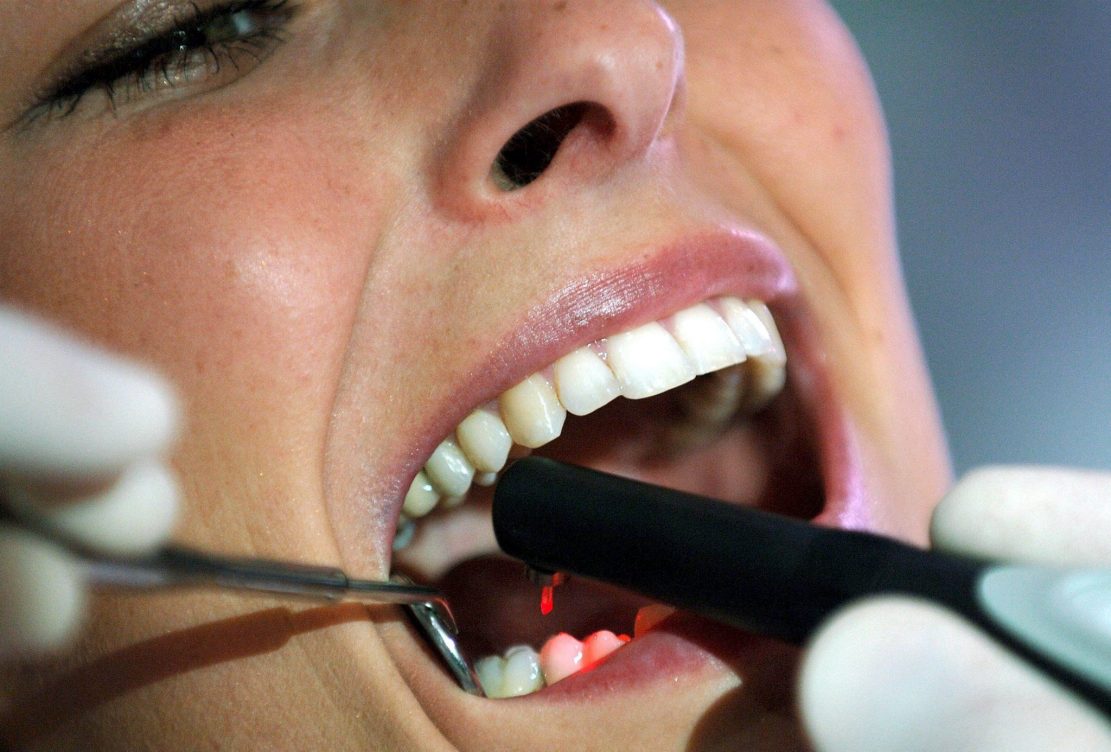 Agenesia dental: por qué algunos dientes nunca llegan a salir