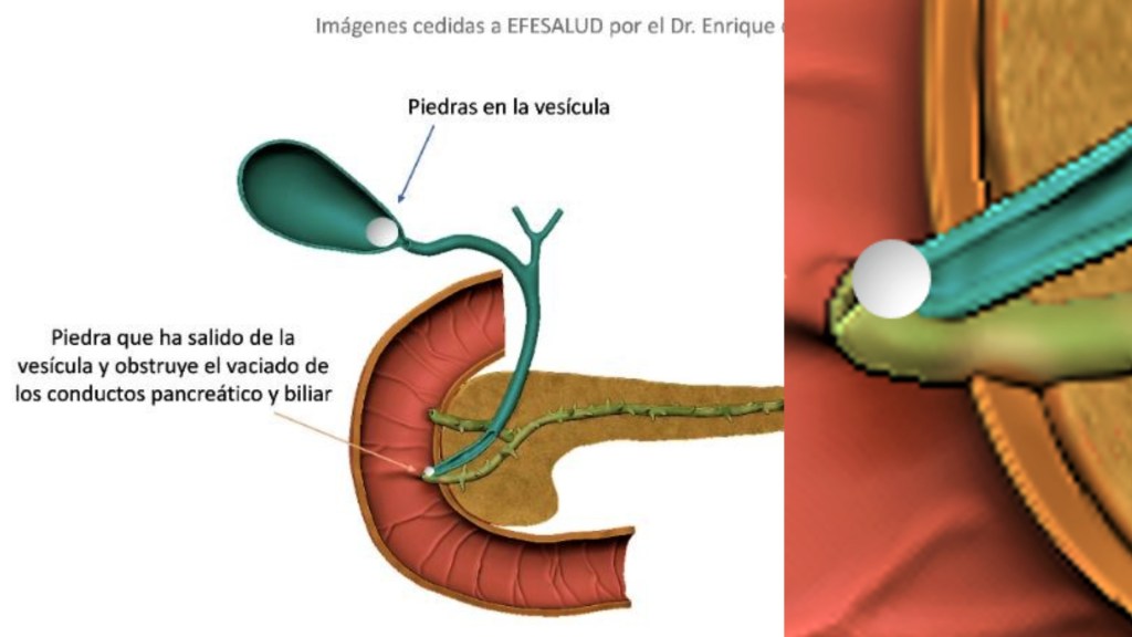 páncreas: colapso por litiasis de la unción de los conductos biliar (colédoco) y del jugo pancreático.
