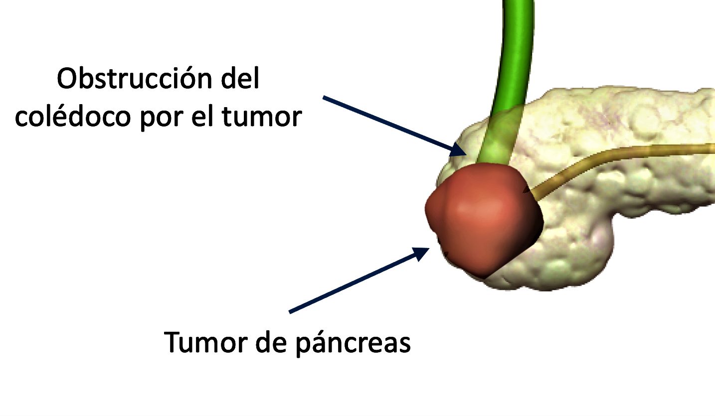 páncreas: tumor o cáncer