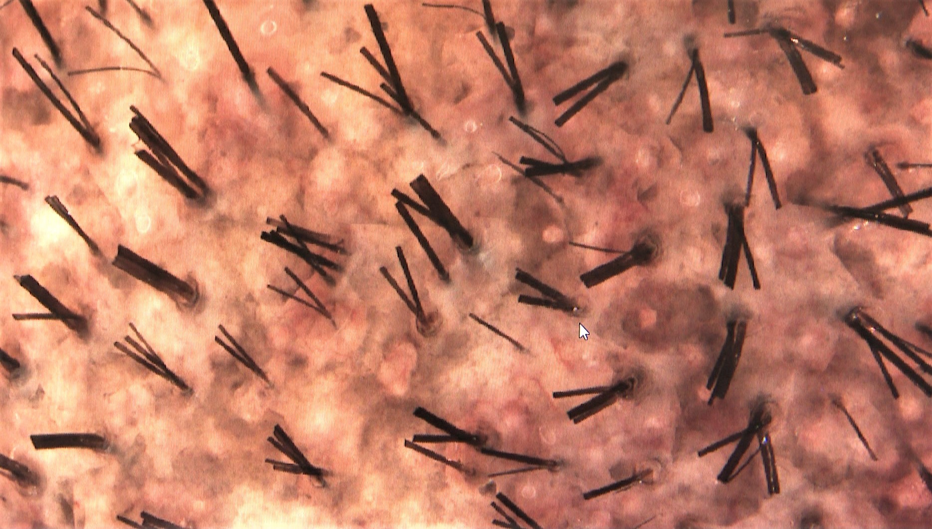 Zona de estudio de la alopecia: fotografía digital de un tricoscopio.