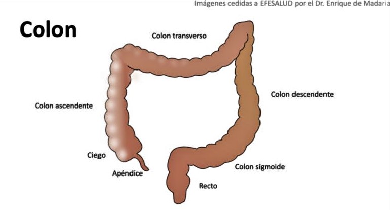 Pólipos malignos y benignos en el colon o intestino grueso.