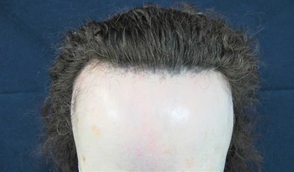 Fibrosing frontal alopecia