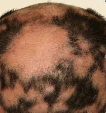 Alopecia areata: tratamientos innovadores