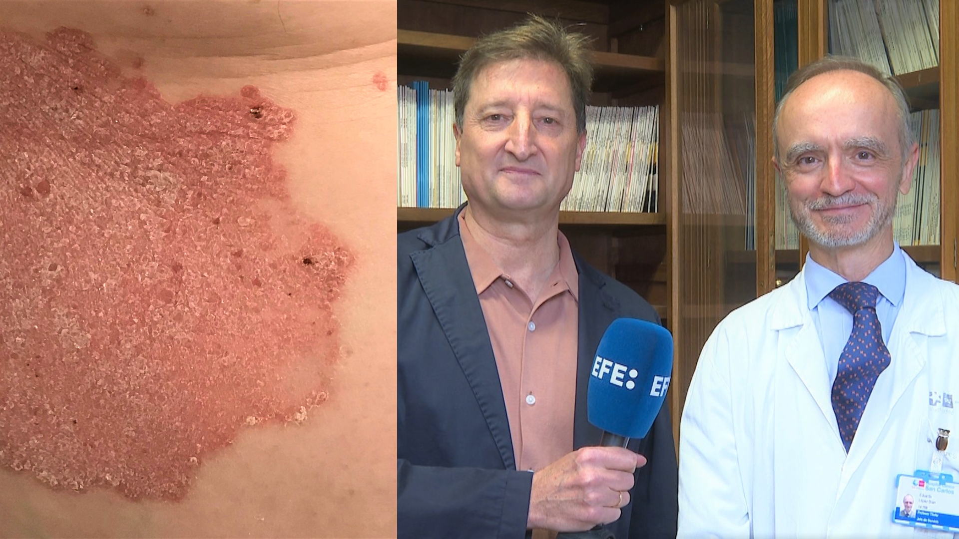 Actualización tratamientos psoriasis.