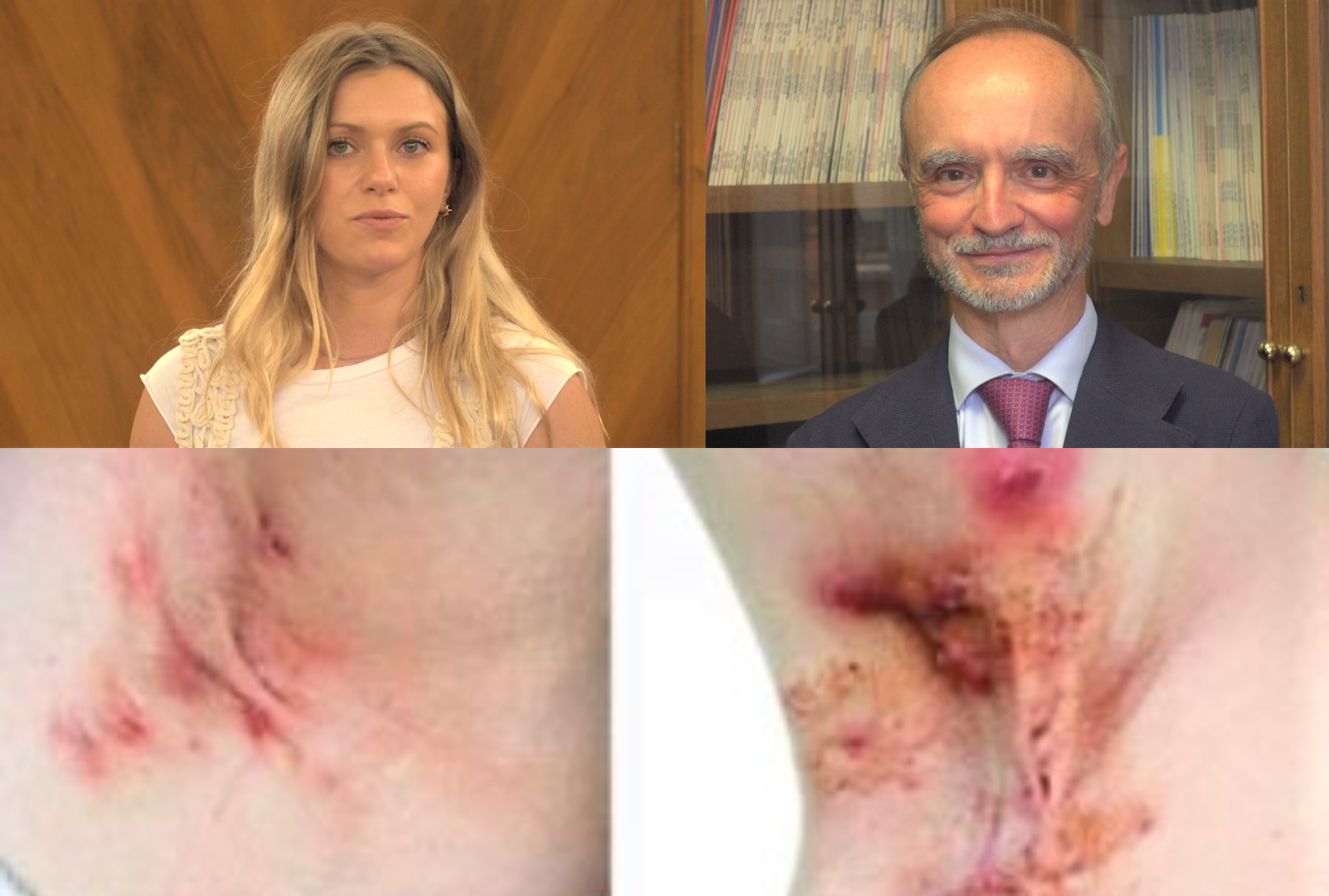 Tratamientos de vanguardia contra la hidradenitis supurativa