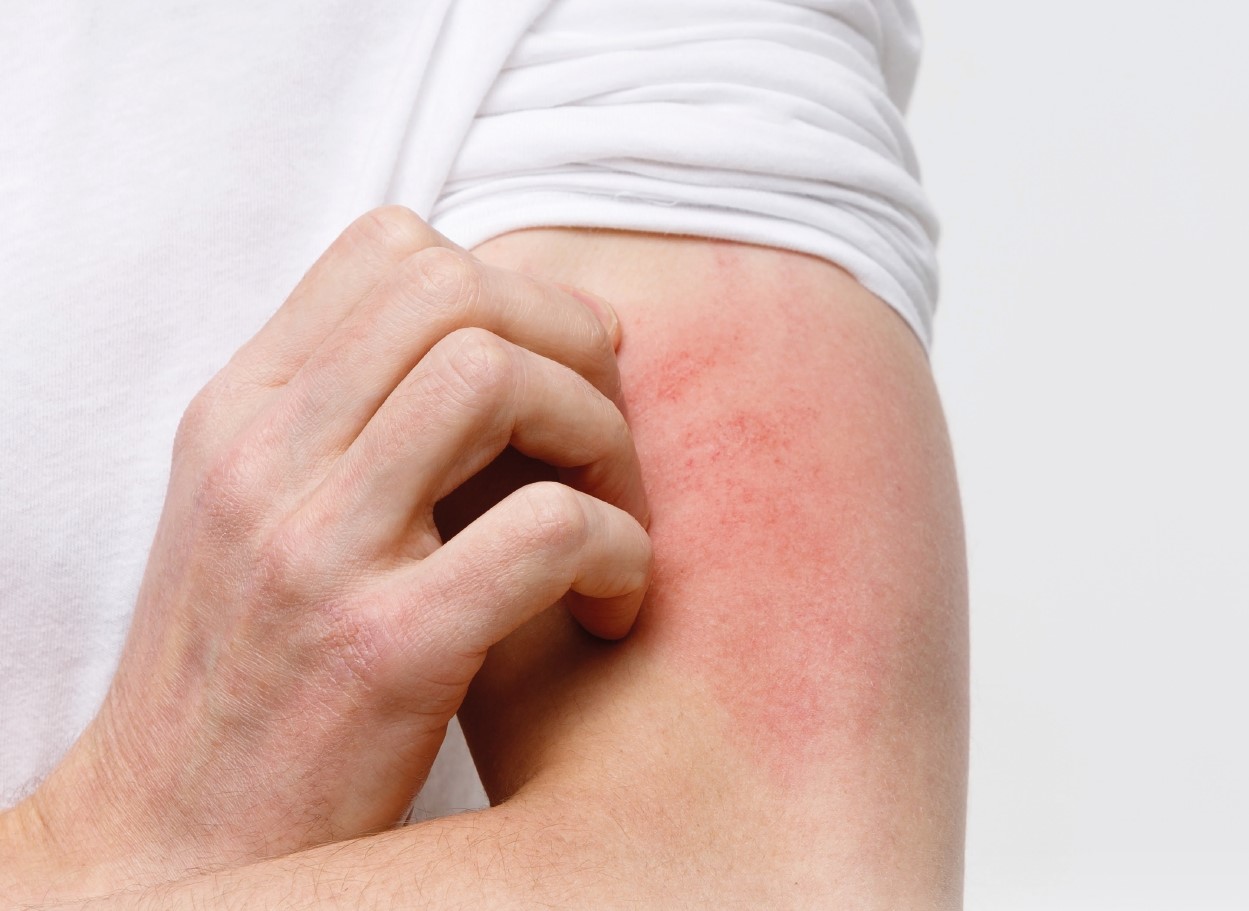 Atlas urticaria crónica