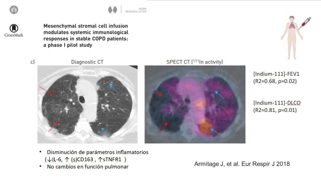 Células mesenquimales y epoc
