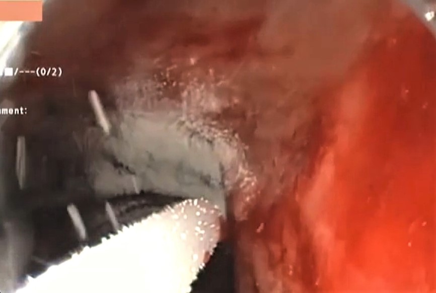 herramientas de la endoscopia.