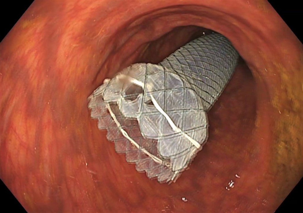 herramientas de la endoscopia.