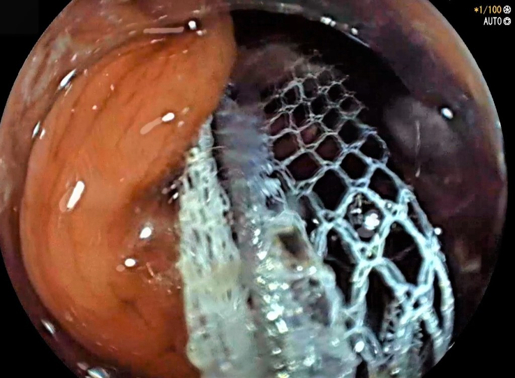 herramientas de la endoscopia.