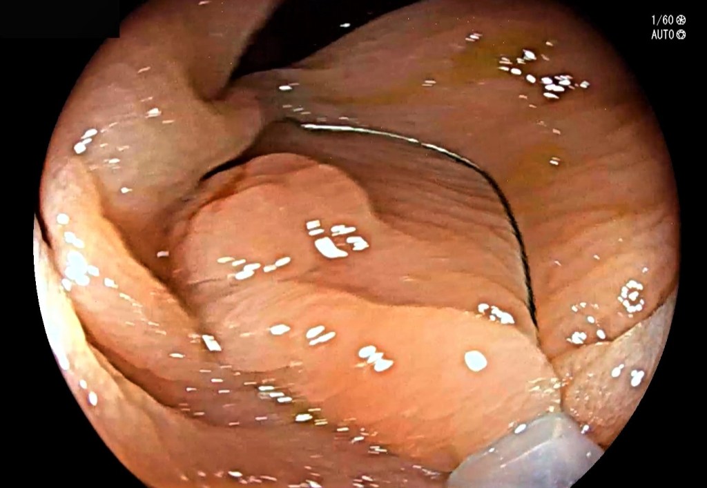 herramientas de la endoscopia.