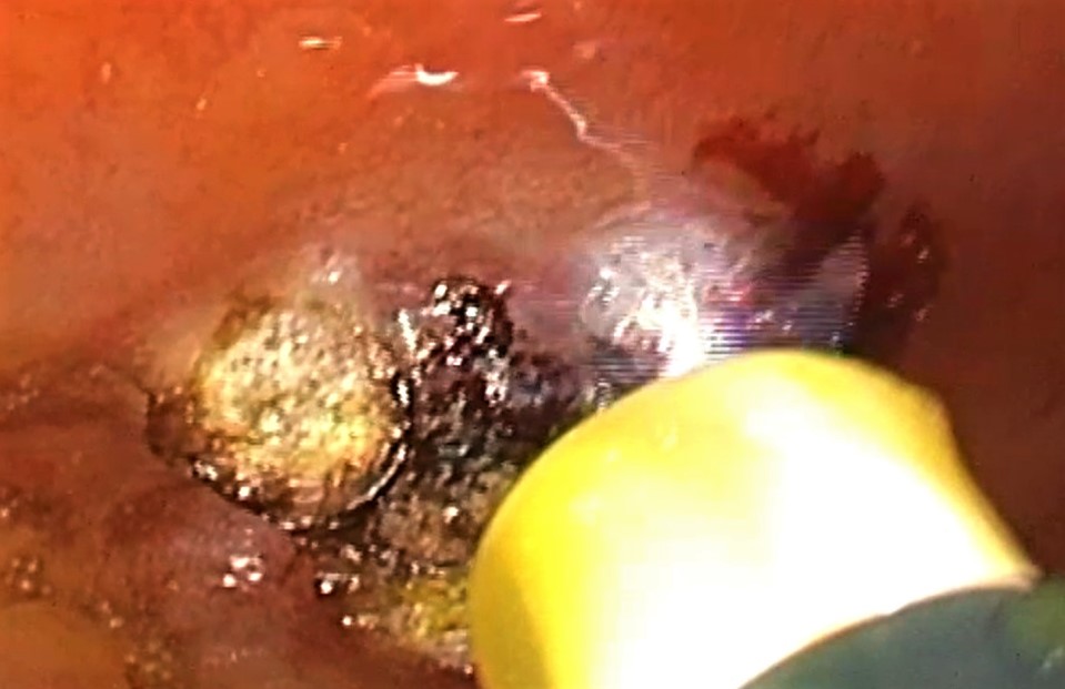 herramientas de la endoscopia.