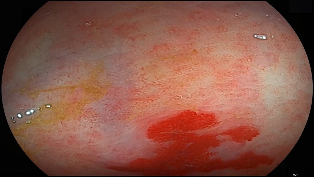 Mitos de las endoscopias digestivas