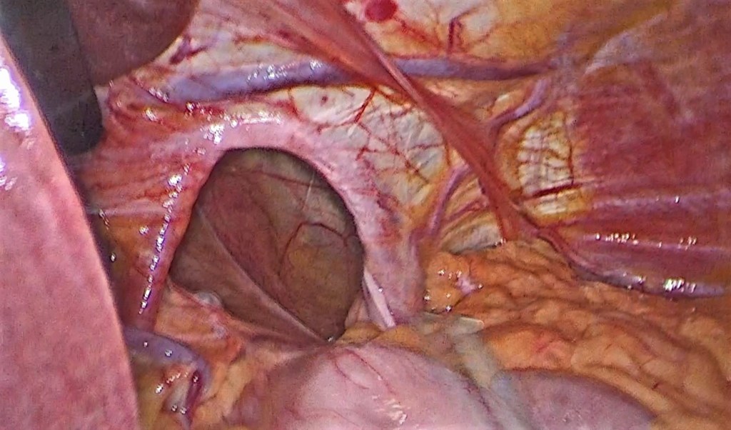 Técnica quirúrgica de funduplicatura de Nissen para corregir la causa del reflujo gastroesofágico.