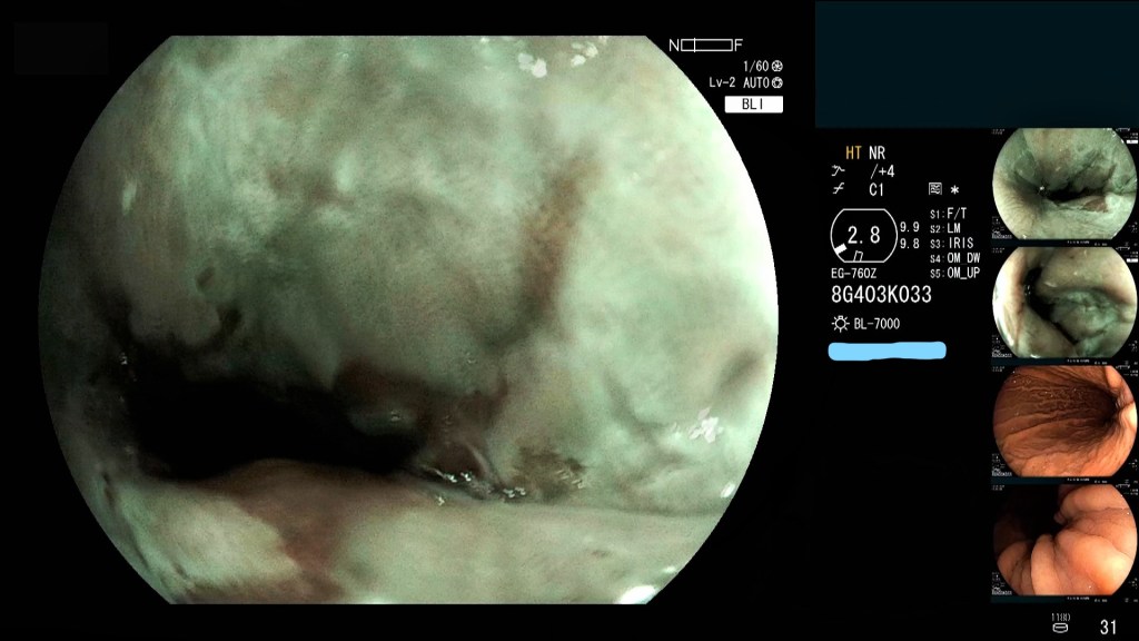Tratamiento endoscópico del reflujo gastroesofágico.