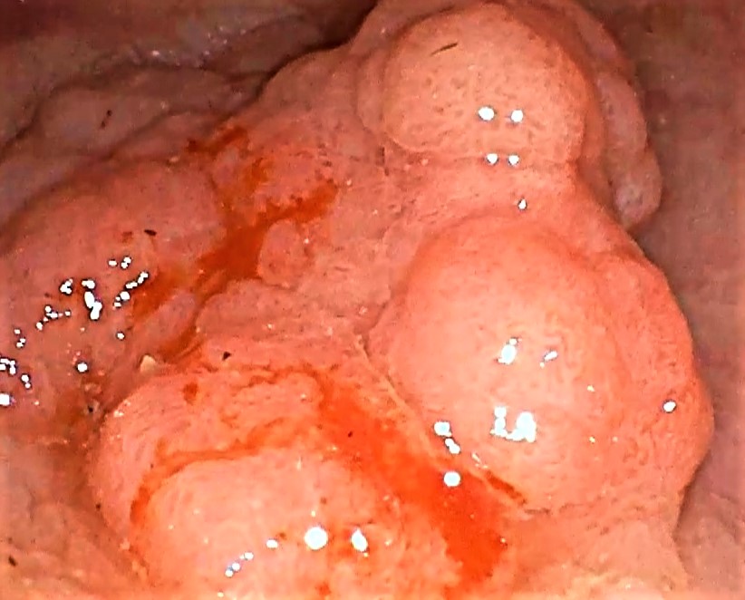 Pólipos benignos y malignos