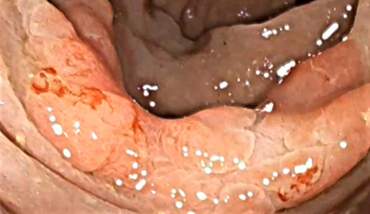 Pólipos benignos y malignos