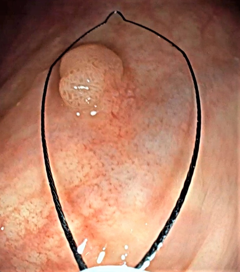 Pólipos benignos y malignos