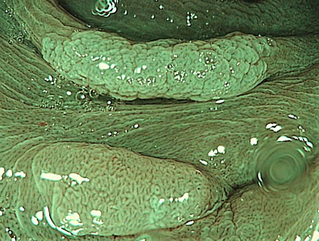 Pólipos benignos y malignos