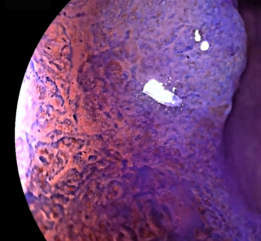 Pólipos benignos y malignos