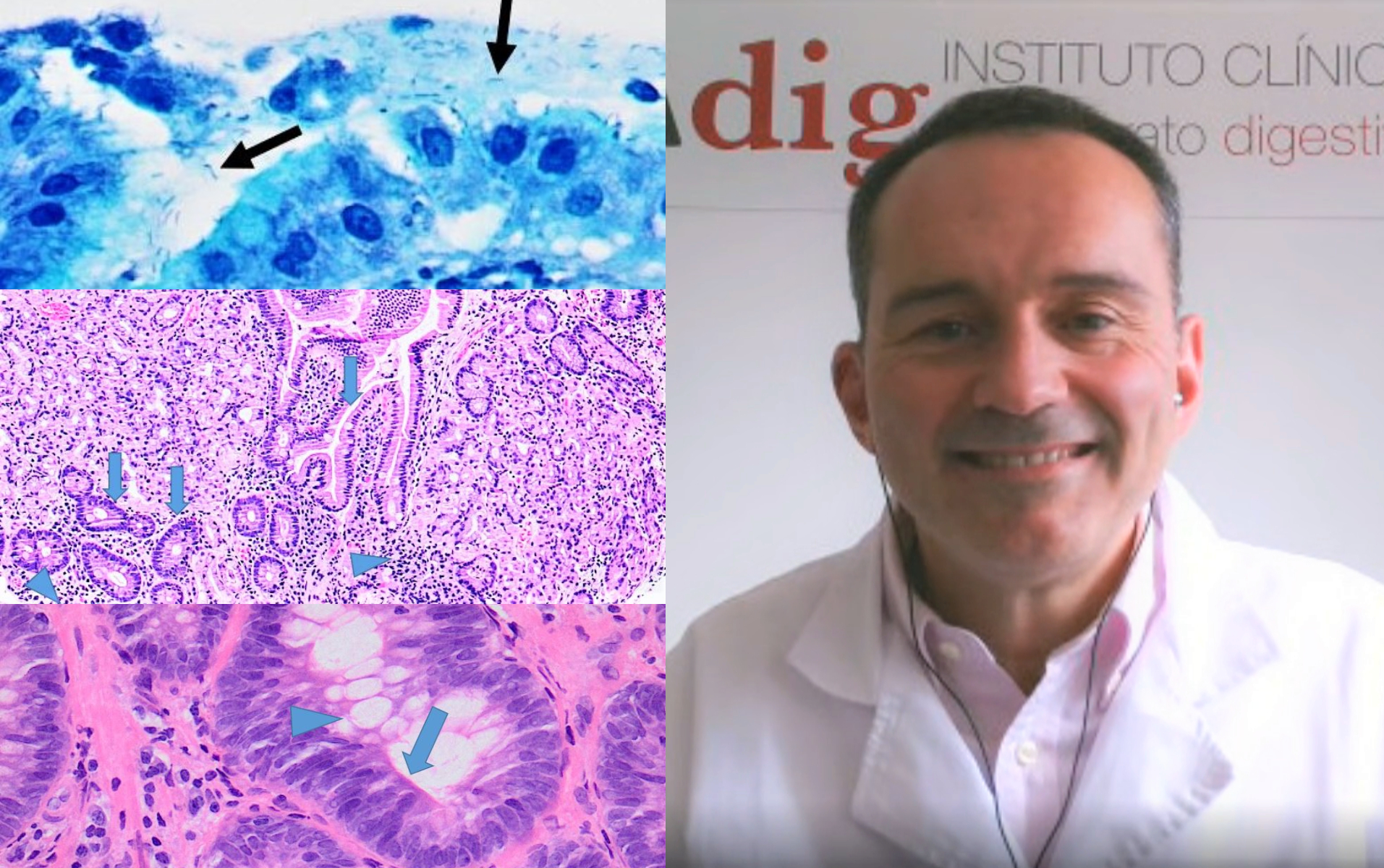 cáncer de estómago