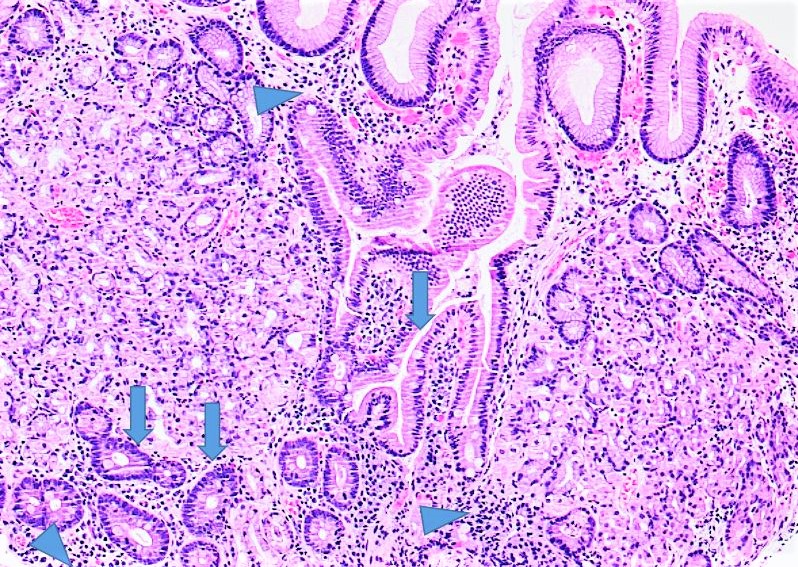 Cáncer gástrico.