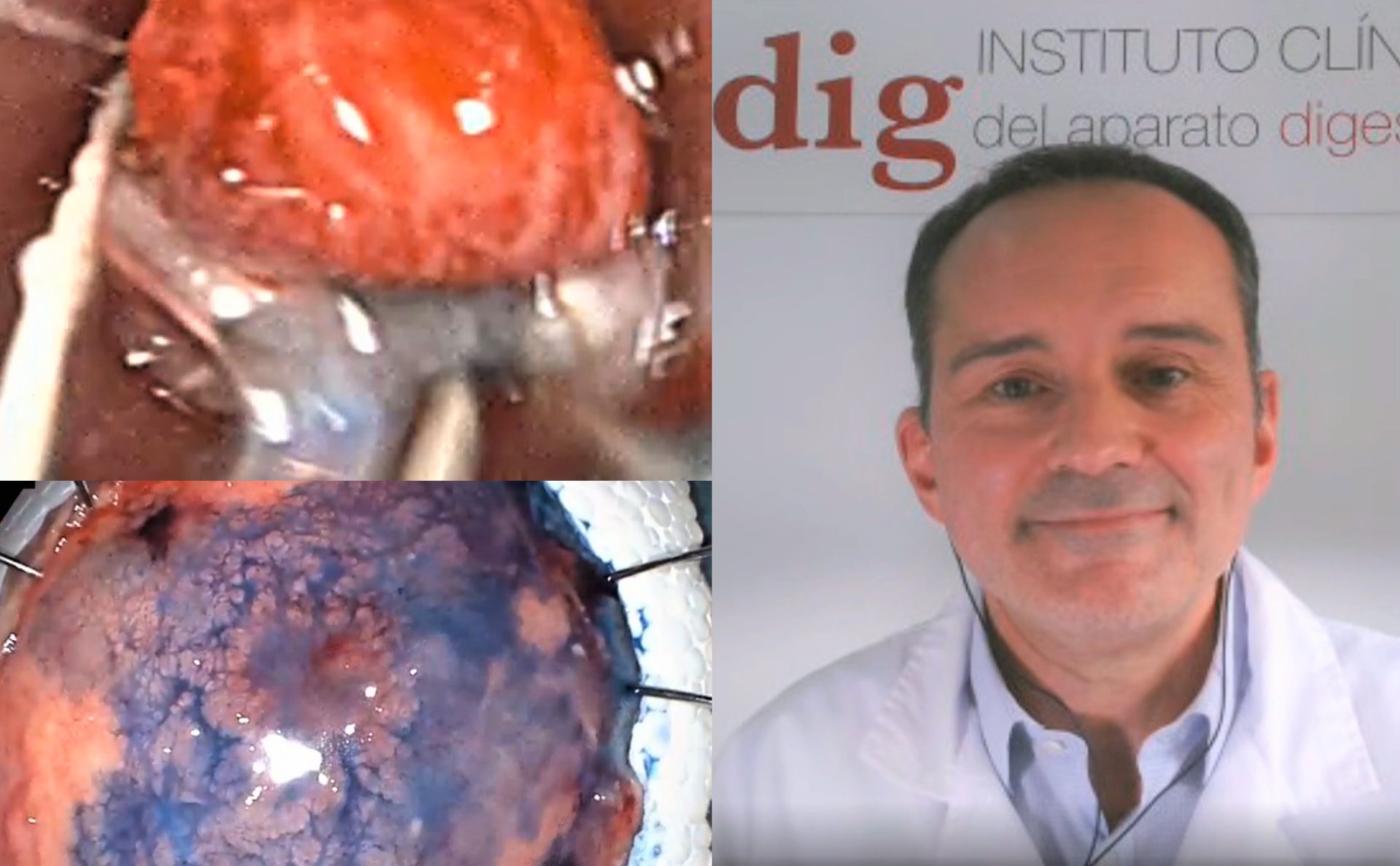 Edoscopia predictiva del cáncer en el tubo digestivo