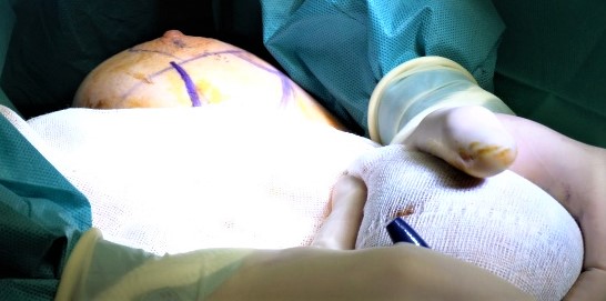 Mamoplastia para corregir mamas tuberosas.