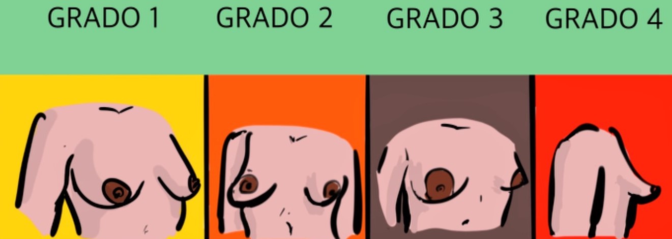 Grados de la mama tuberosa que afecta a las mujeres.