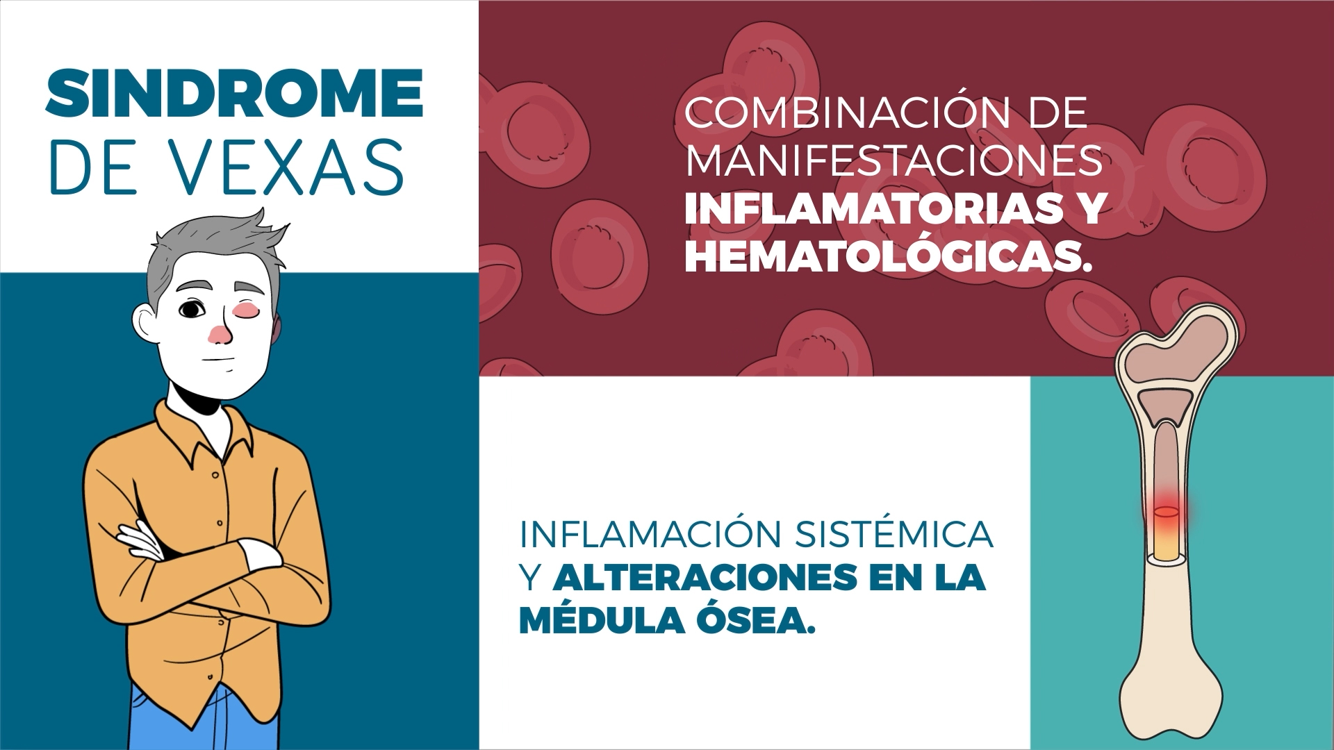 síndrome de VEXAS