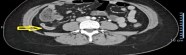 Dolor Agudo En La Zona Derecha Del Abdomen Apendicitis Dolor Agudo En La Zona Derecha Del Abdomen Apendicitis