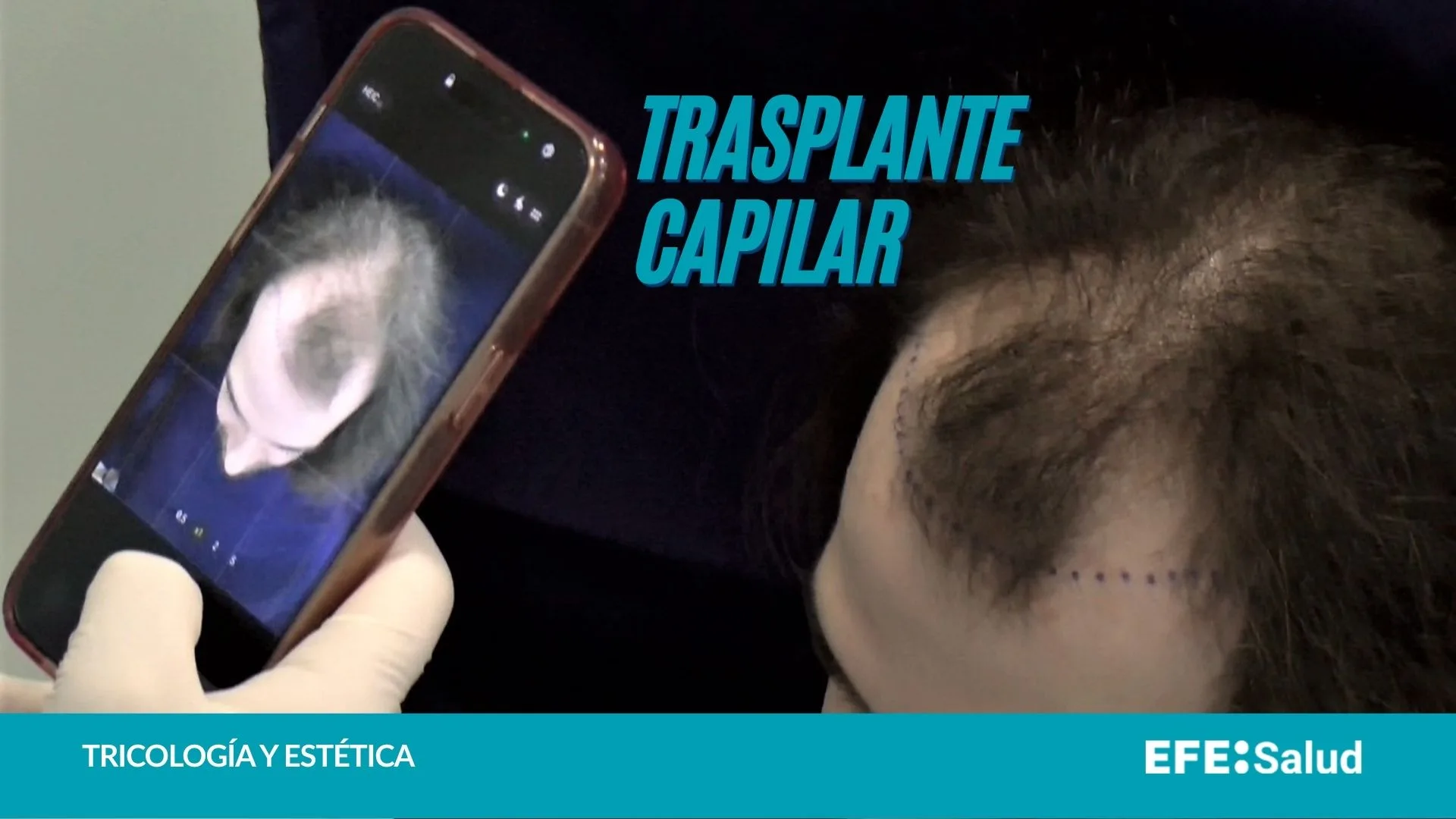 Trasplante capilar hombre joven.