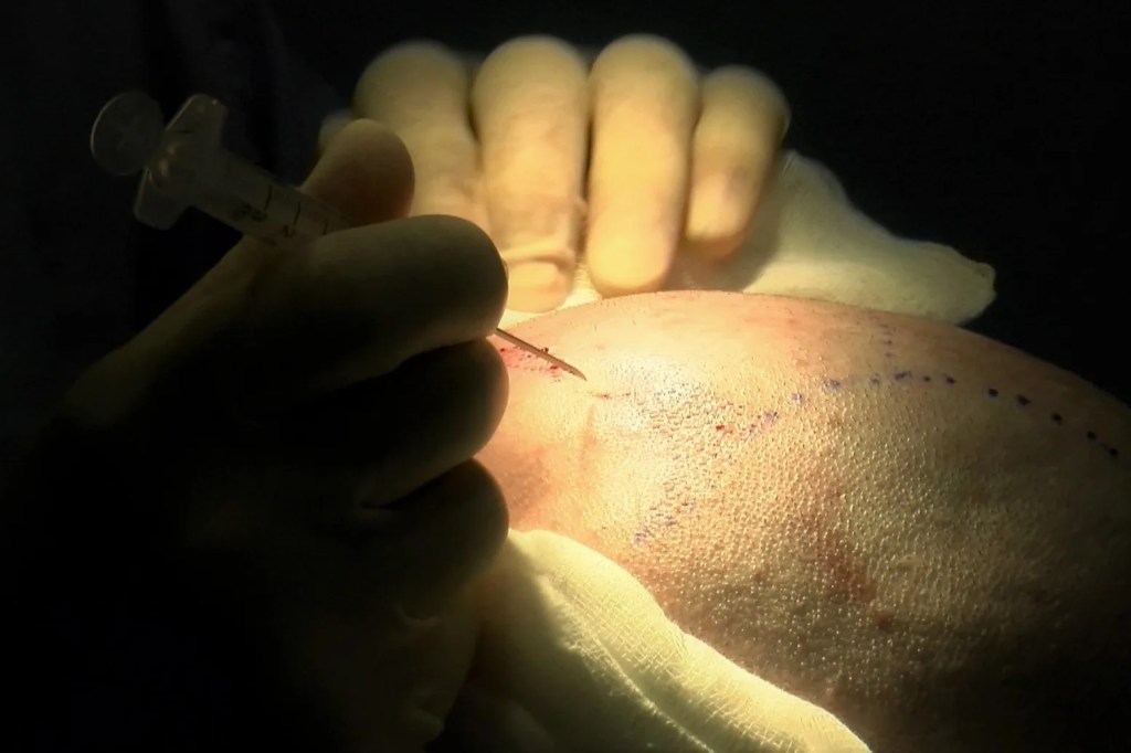 Trasplante capilar: anestesia.