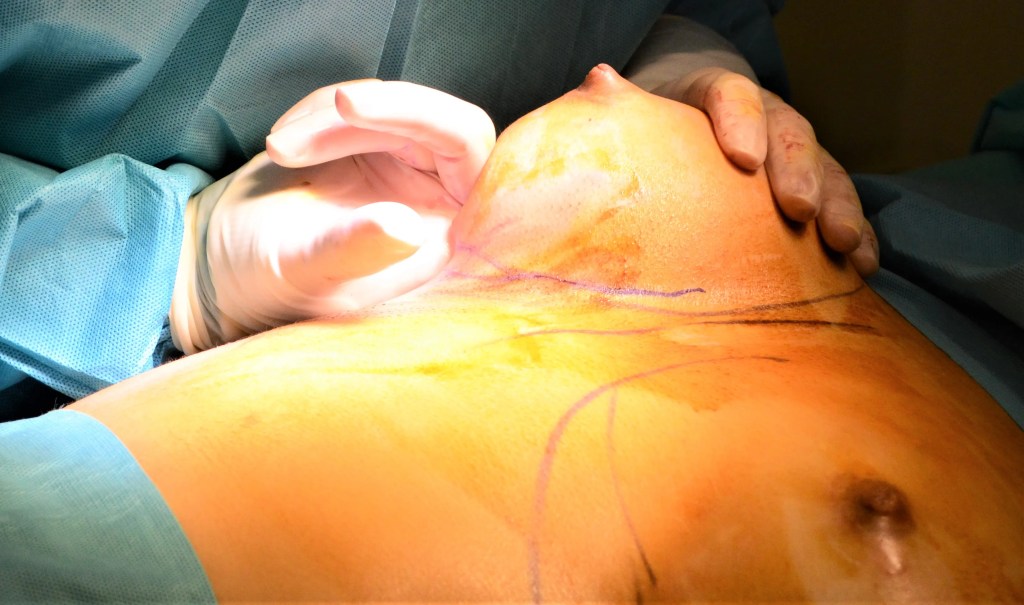 Crugía de mama: aumento de pecho.