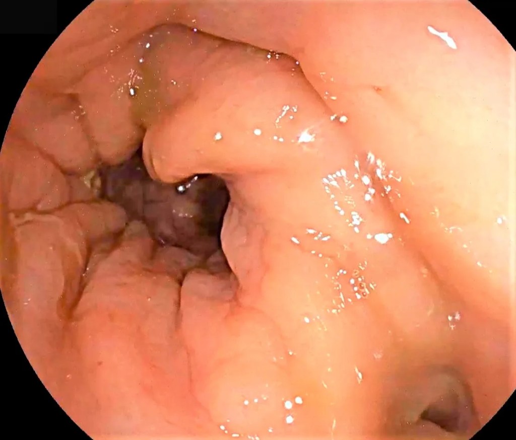 Colitis ulcerosa.