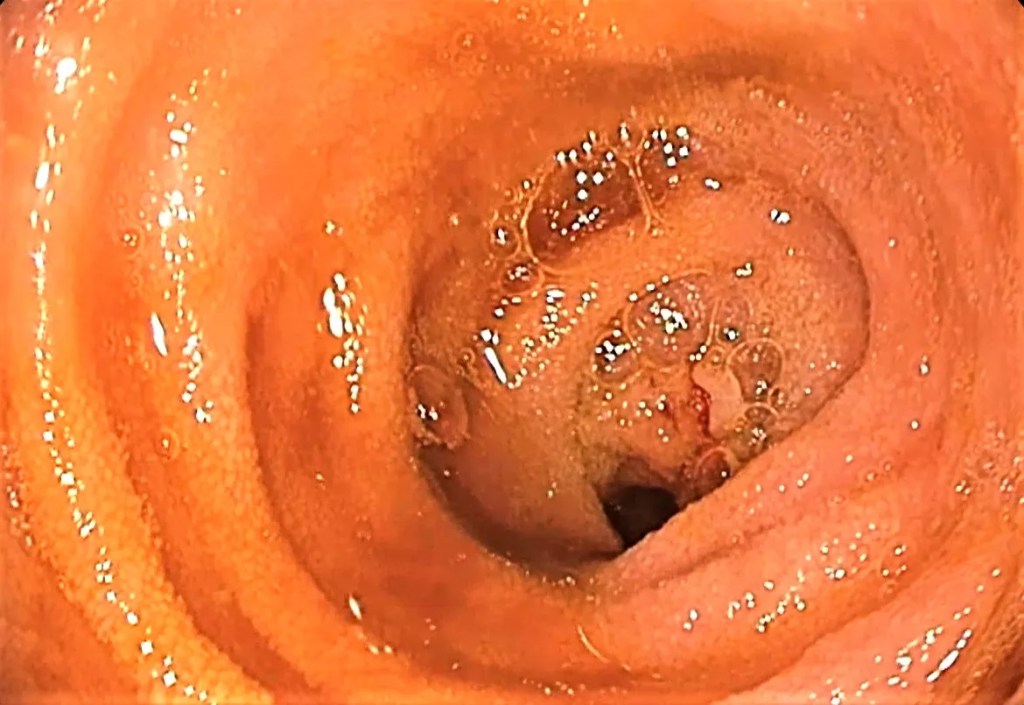 Colitis ulcerosa.