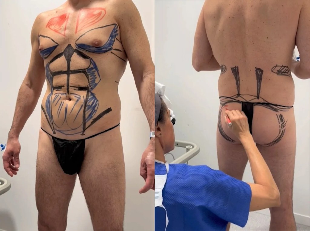 cirugía de lipoescultura.