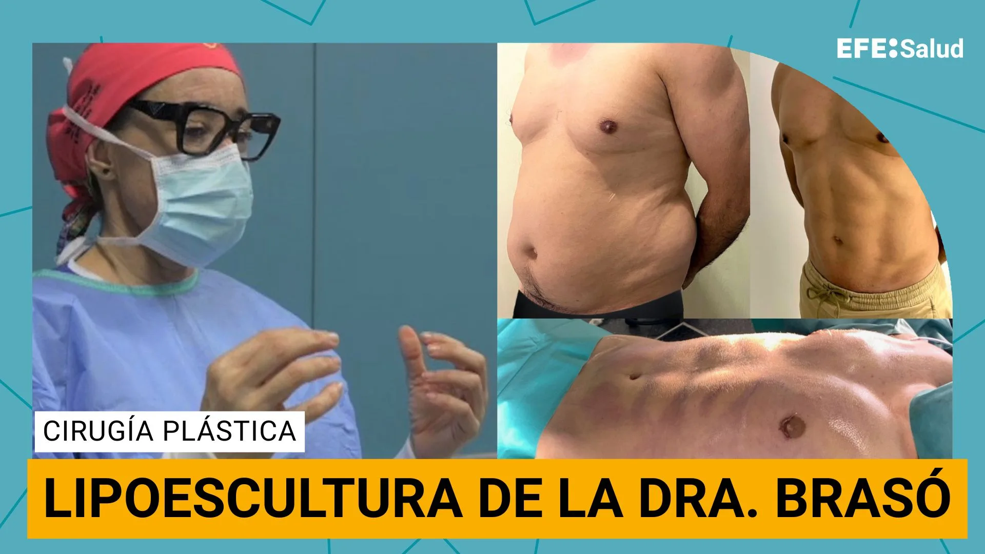 lipoescultura