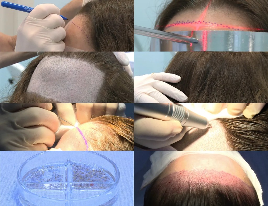 Alopecia frontal fibrosante.