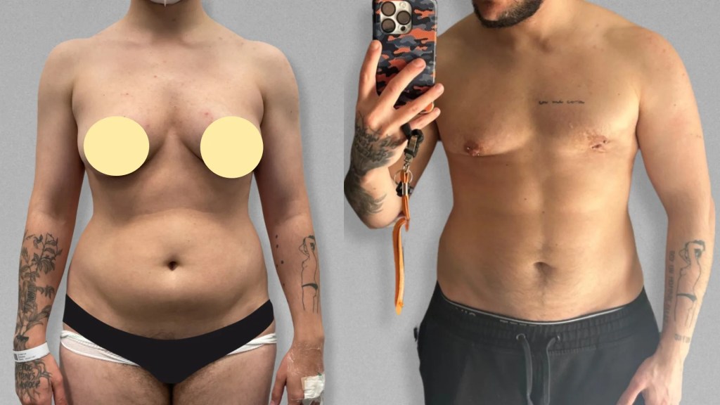 masculinización corporal con cirugía ante la disforia de género.