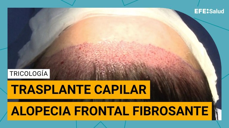 Alopecia frontal fibrosante.