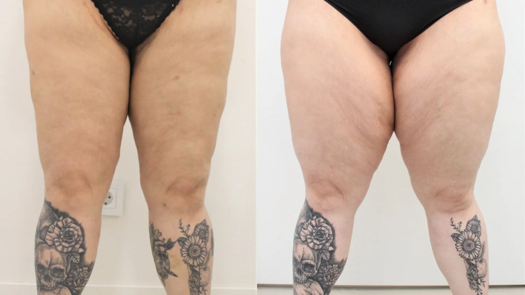 Lipedema.