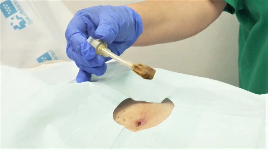 Gastrostomía.