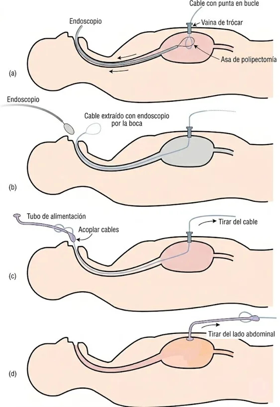 Gastrostomía.