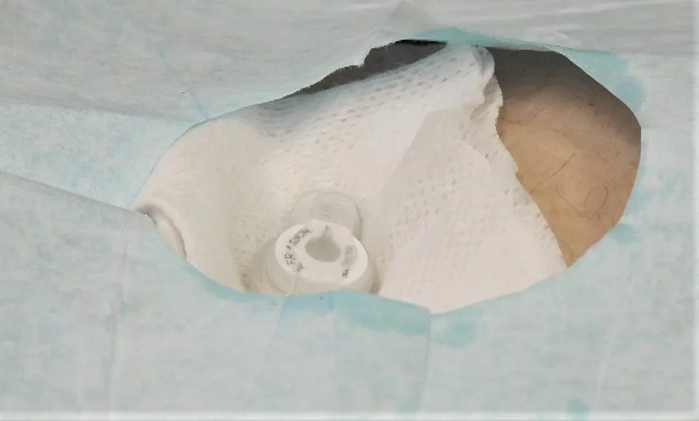 Gastrostomía.